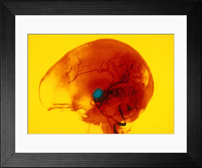 Framed Print : Cerebral Angiogram Framed Print : Cerebral Angiogram