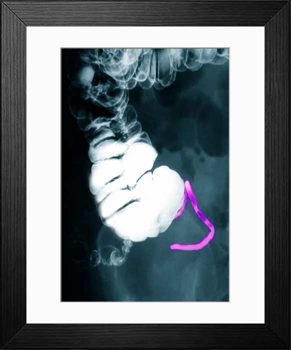 Framed Print : Appendix x-ray with barium contrast Framed Print : Appendix x-ray with barium contrast