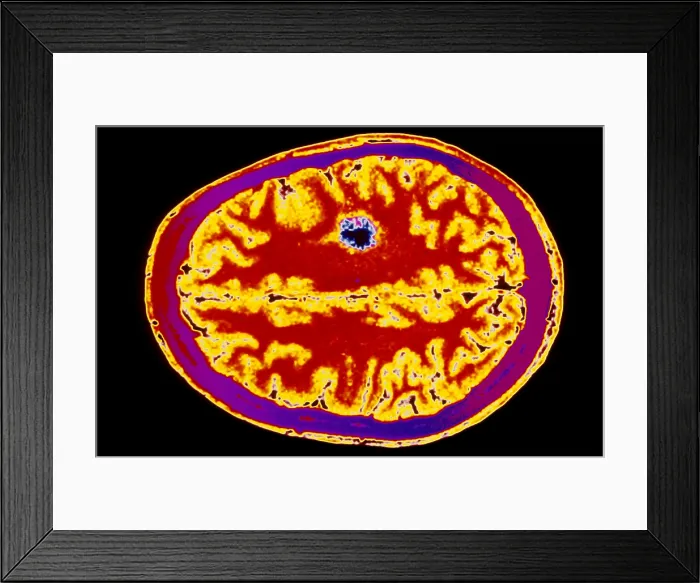 Framed Print : MRI of brain tumor