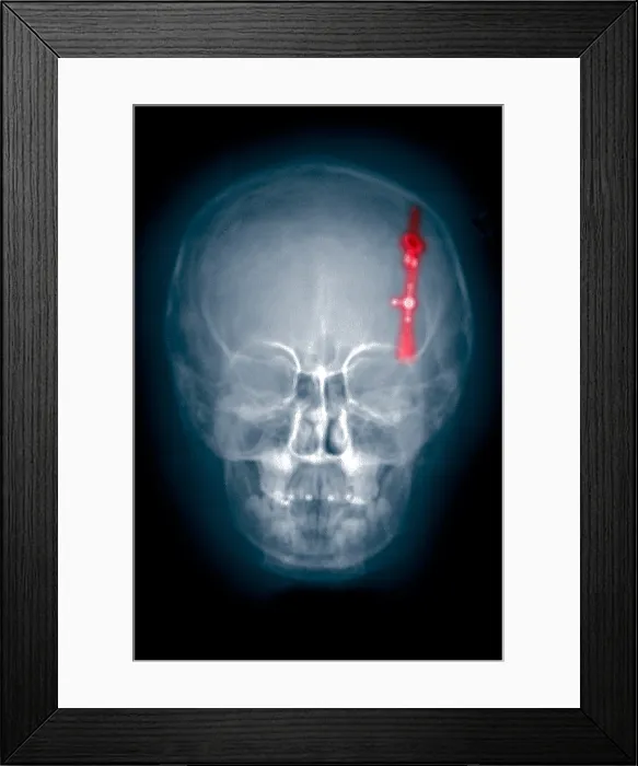 Framed Print : Skull x-ray of a shunt in the brain ventricle Framed Print : Skull x-ray of a shunt in the brain ventricle