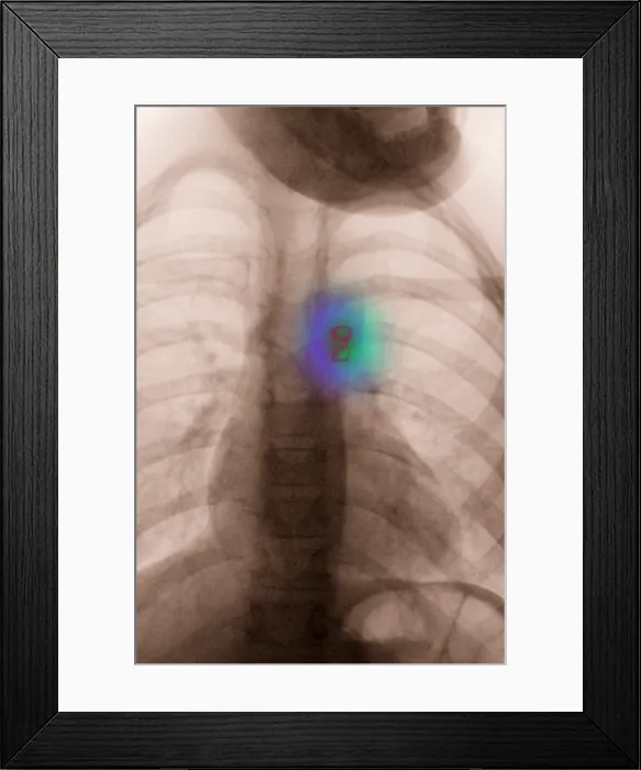 Framed Print : Atrial Septal Defect Treatment