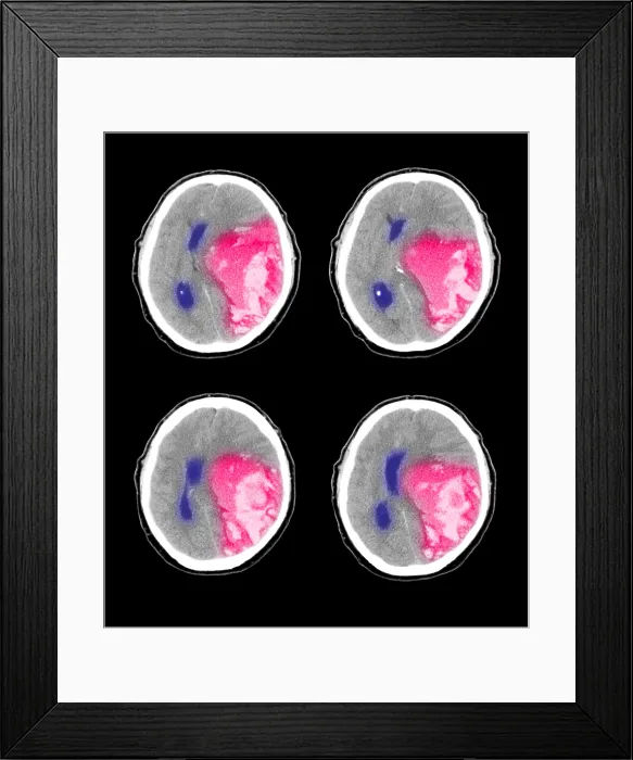 Framed Print : Hemorrhagic Stroke Framed Print : Hemorrhagic Stroke