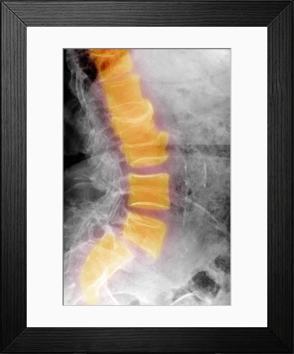 Framed Print : Spondylolisthesis Framed Print : Spondylolisthesis
