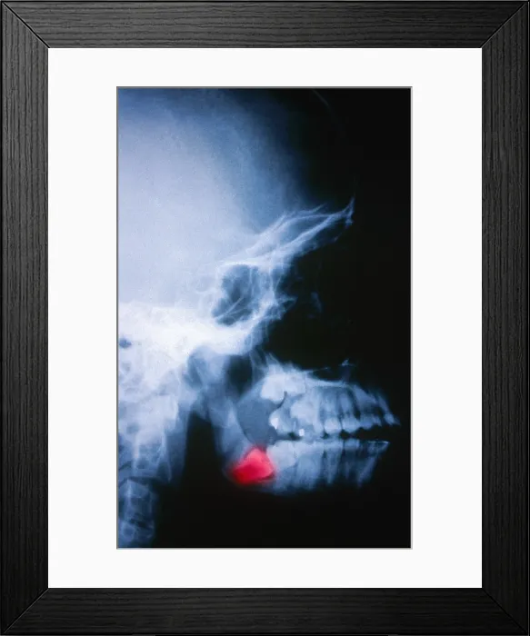 Framed Print : Impacted Wisdom Tooth, X-ray Framed Print : Impacted Wisdom Tooth, X-ray