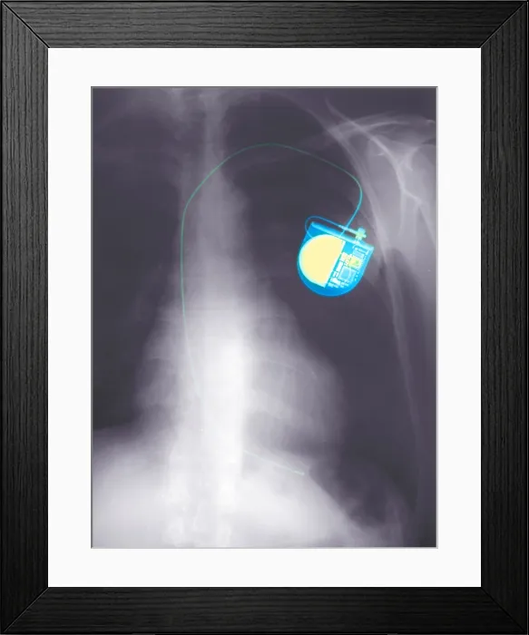 Framed Print : Chest x-ray of a pacemaker Framed Print : Chest x-ray of a pacemaker