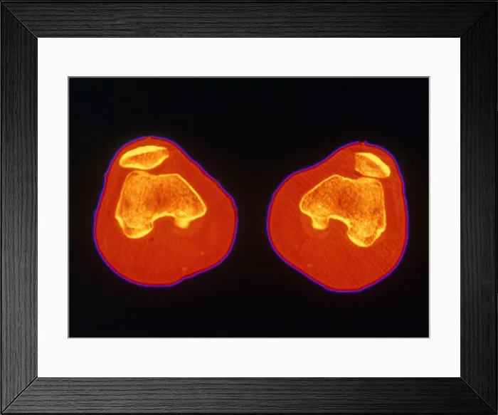 Framed Print : Knees, CT Scan
