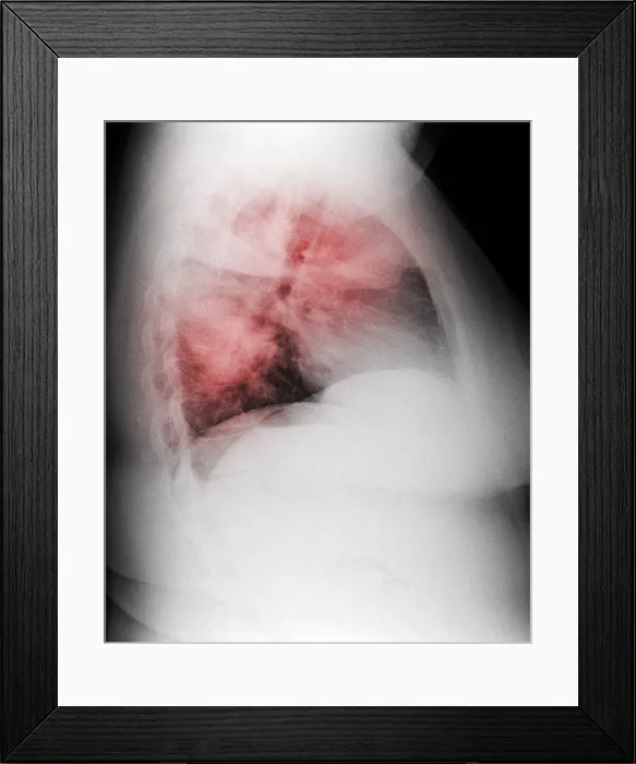 Framed Print : Atypical Pneumonia in Smoker, X-ray Framed Print : Atypical Pneumonia in Smoker, X-ray