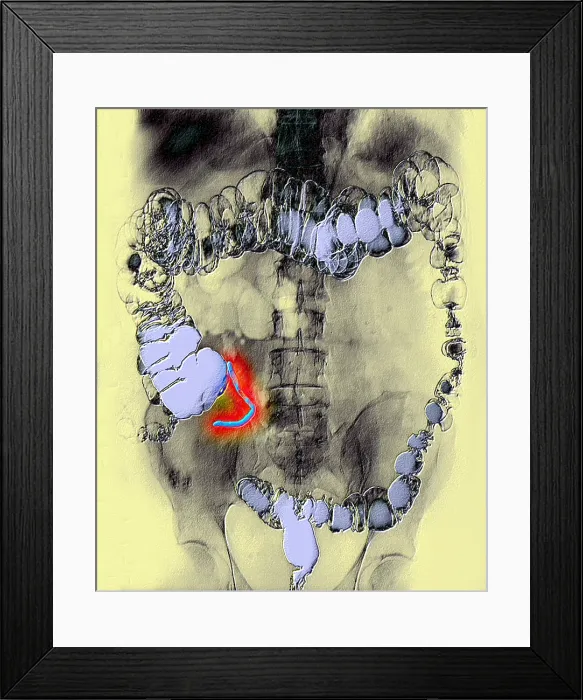 Framed Print : Appendix x-ray with barium contrast Framed Print : Appendix x-ray with barium contrast