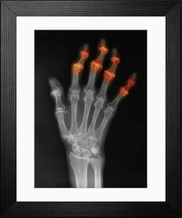 Framed Print : Degenerative Arthritis Framed Print : Degenerative Arthritis
