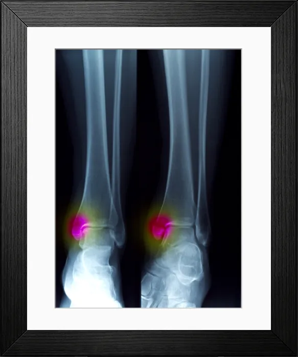 Framed Print : Ankle Fracture Framed Print : Ankle Fracture