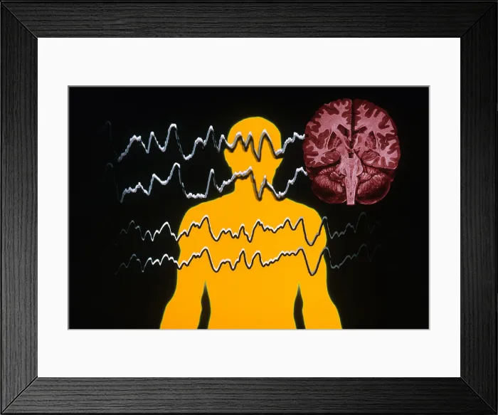Framed Print : EEG of Tonic-clonic Seizure Framed Print : EEG of Tonic-clonic Seizure