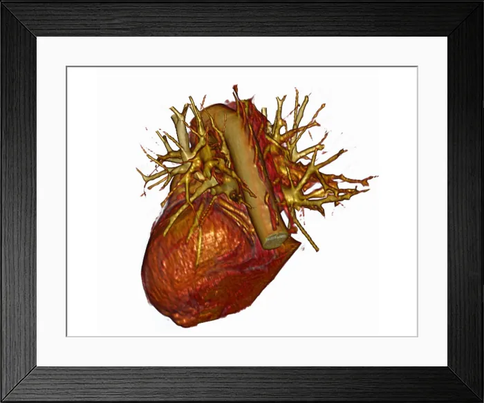 Framed Print : 3D CT Scan of Heart Framed Print : 3D CT Scan of Heart