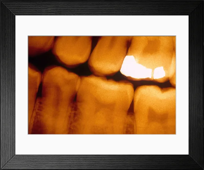 Framed Print : Filling, X-ray Framed Print : Filling, X-ray