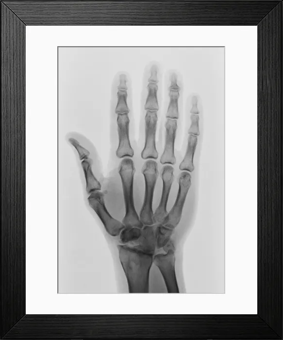 Framed Print : Healthy Hand X-ray Framed Print : Healthy Hand X-ray