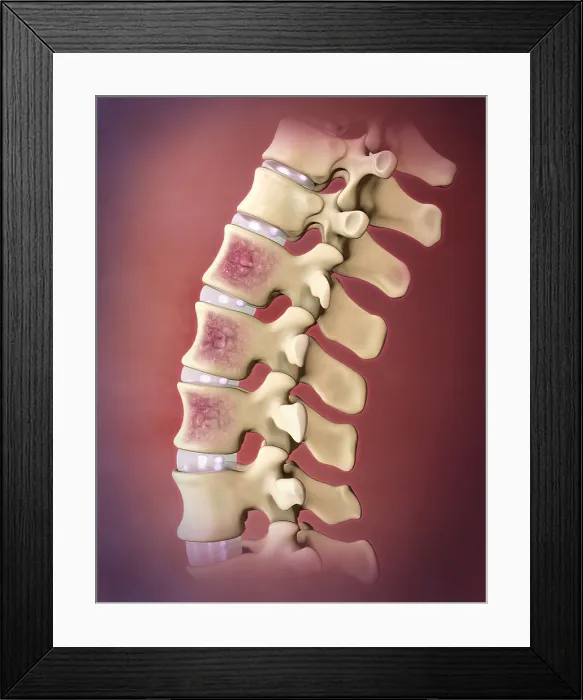 Framed Print : Multiple Myeloma, Spine Framed Print : Multiple Myeloma, Spine