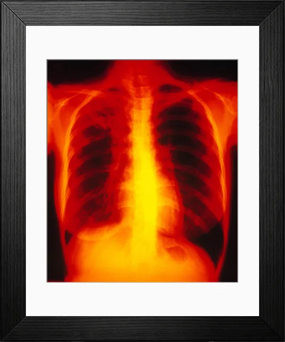 Framed Print : Tuberculosis, X-ray Framed Print : Tuberculosis, X-ray