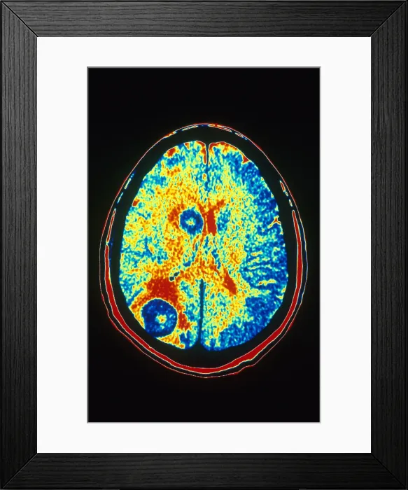 Framed Print : Brain Cancer, CT Scan