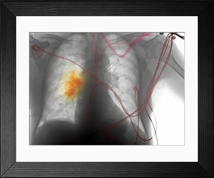 Framed Print : X-ray, Smoker's Chest Framed Print : X-ray, Smoker's Chest