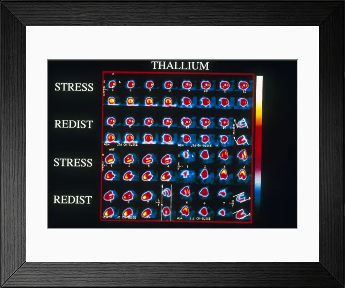 Framed Print : Coronary Heart Disease Framed Print : Coronary Heart Disease