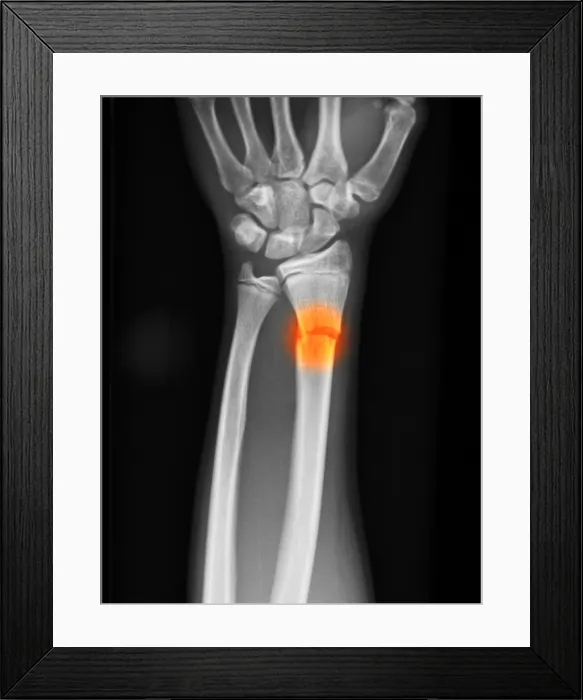 Framed Print : Distal Radius Fracture in a 14 Year Old Boy Framed Print : Distal Radius Fracture in a 14 Year Old Boy