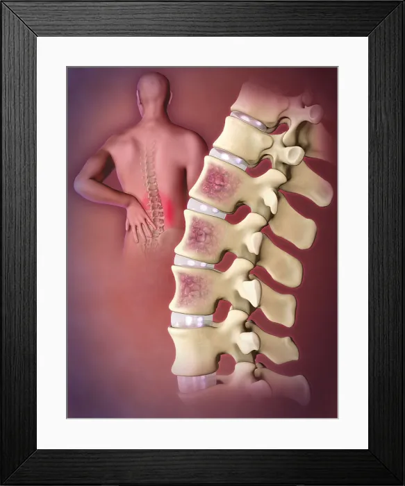 Framed Print : Multiple Myeloma