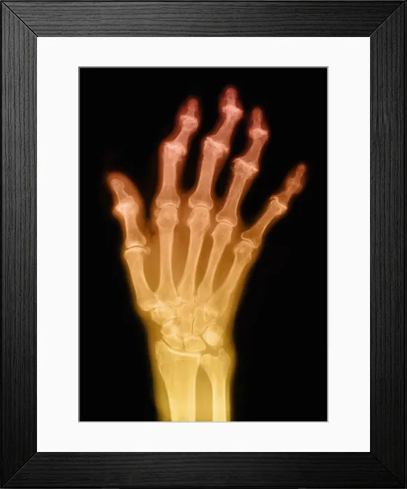 Framed Print : Degenerative Arthritis Framed Print : Degenerative Arthritis