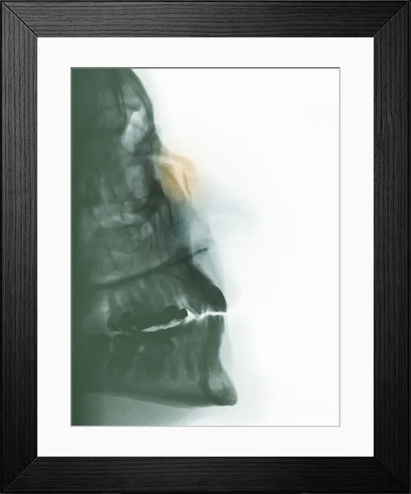 Framed Print : Nose Fracture Framed Print : Nose Fracture