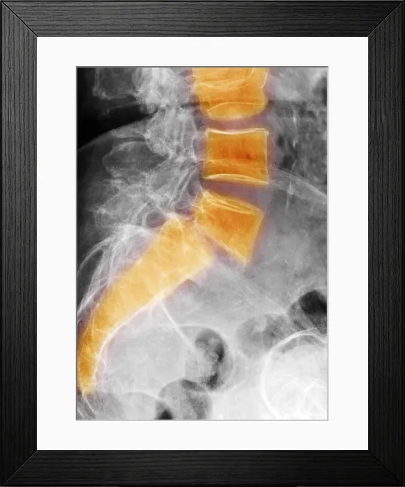 Framed Print : Spondylolisthesis Framed Print : Spondylolisthesis