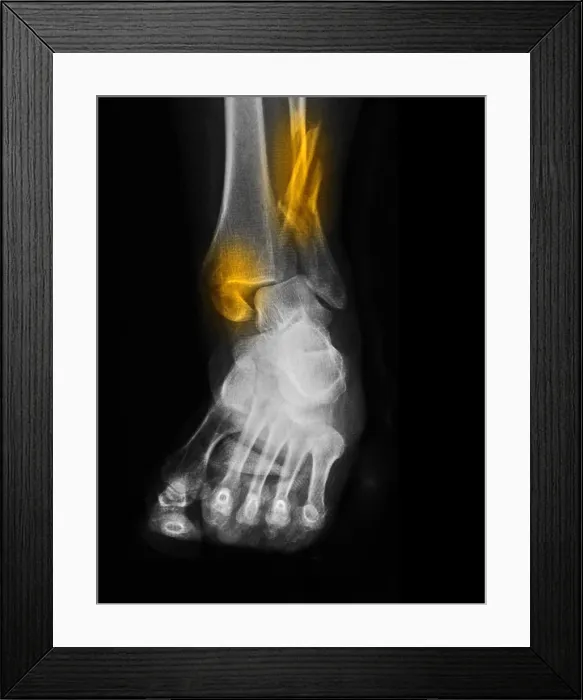 Framed Print : Fractured and Dislocated Ankle Framed Print : Fractured and Dislocated Ankle
