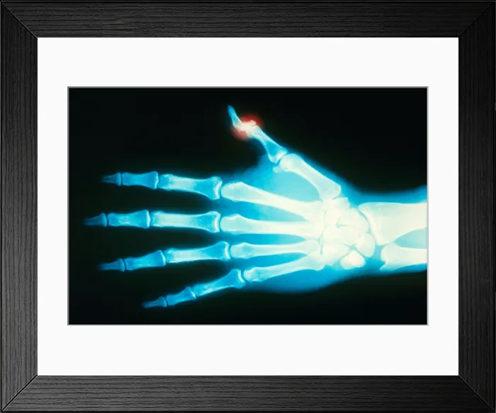 Framed Print : Fractured Thumb, X-ray Framed Print : Fractured Thumb, X-ray