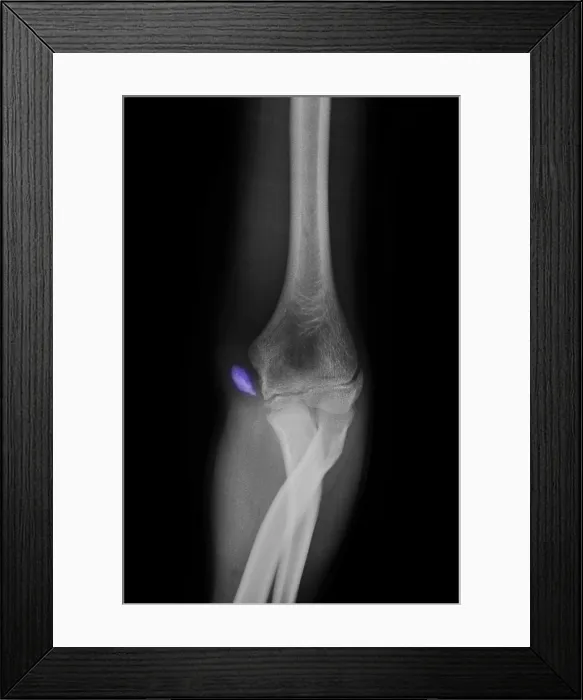 Framed Print : Little League Elbow Syndrome Framed Print : Little League Elbow Syndrome