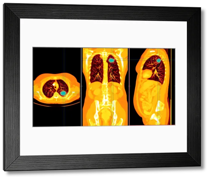Framed Print : Lung Cancer, CT Scan