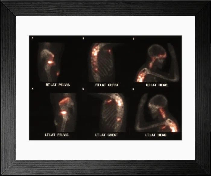Framed Print : Bone scan showing multiple metastases Framed Print : Bone scan showing multiple metastases
