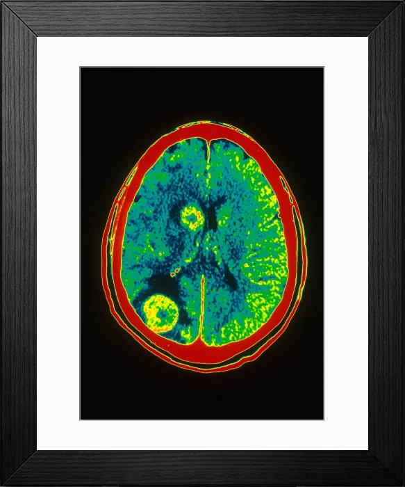 Framed Print : Brain Cancer, CT Scan