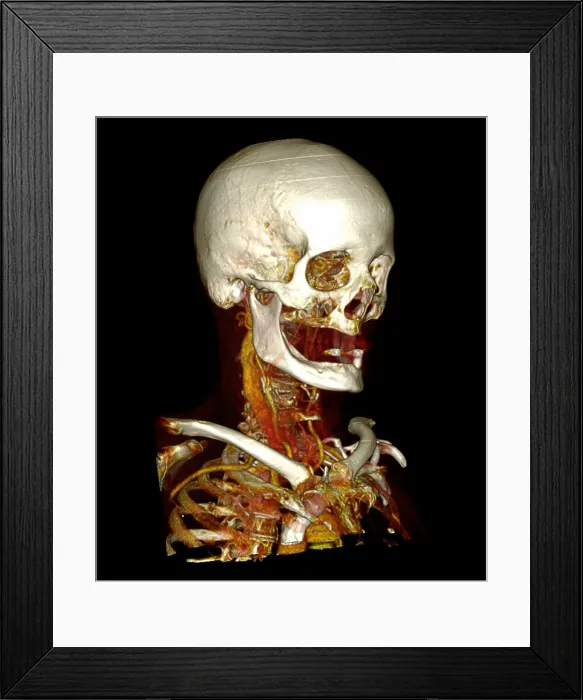 Framed Print : Male Skull & Arterial System Framed Print : Male Skull & Arterial System
