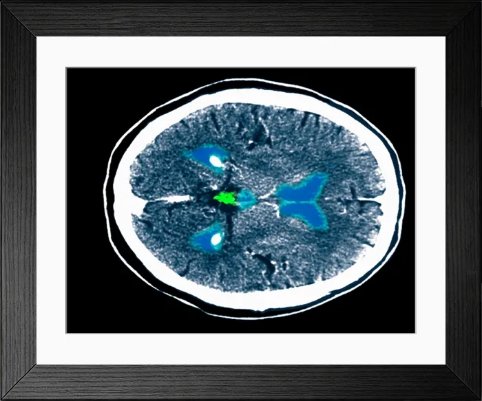 Framed Print : CT scan of a normal brain Framed Print : CT scan of a normal brain