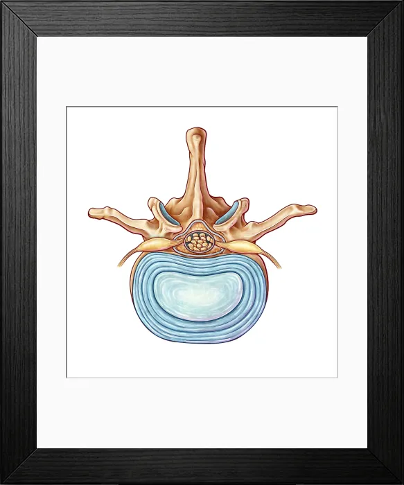 Framed Print : Lumbar Vertebra and Disk, illustration Framed Print : Lumbar Vertebra and Disk, illustration