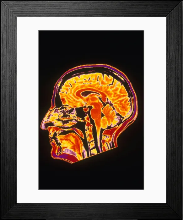 Framed Print : MRI of Head