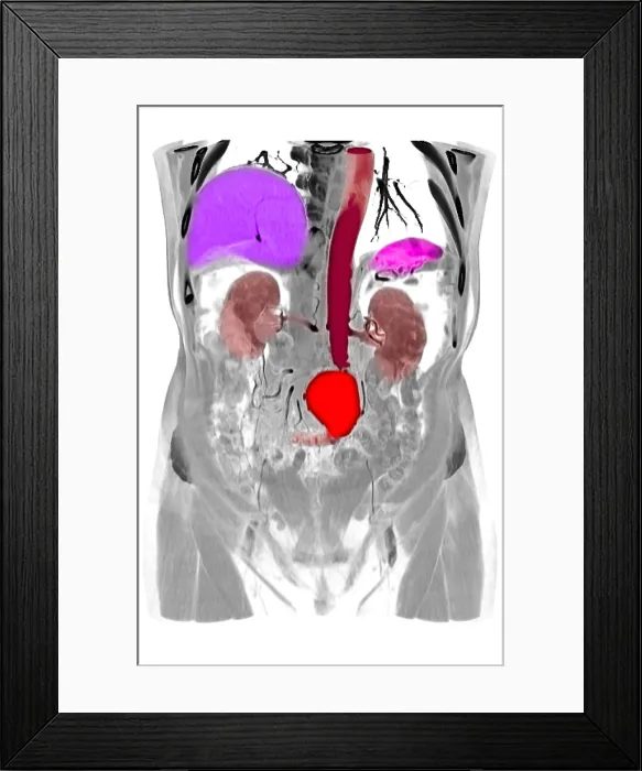 Framed Print : CT Scan of Abdominal Aortic Aneurysm