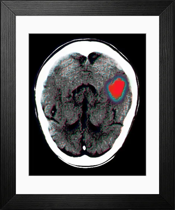 Framed Print : Brain hemorrhage Framed Print : Brain hemorrhage