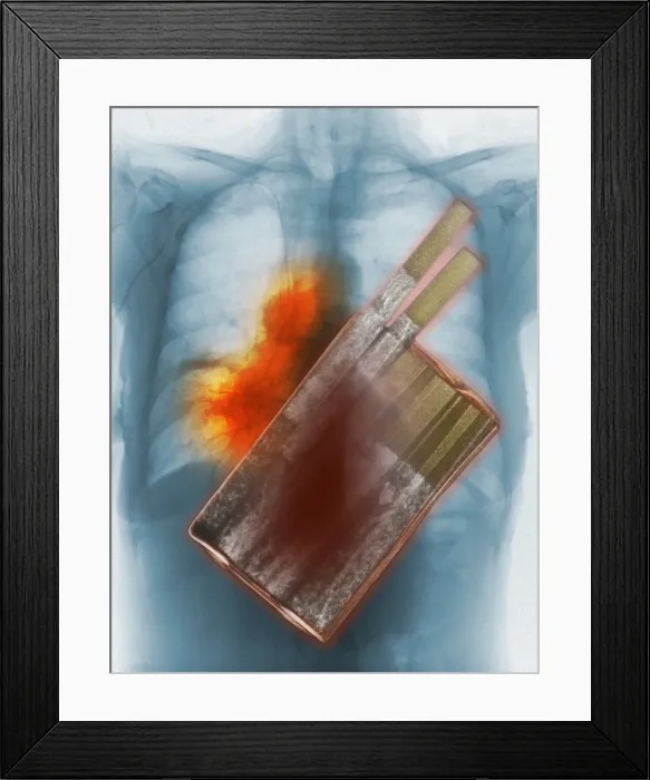 Framed Print : Cigarettes and Lung Cancer Framed Print : Cigarettes and Lung Cancer