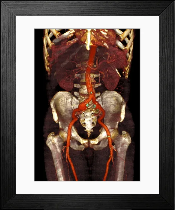 Framed Print : Aneurysm. Three views of a lower limb angio CT of a patient with atherosclerotic