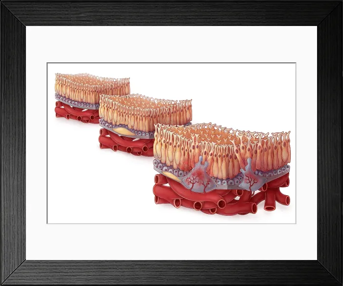 Framed Print : Age-related Macular Degeneration, Illustration Framed Print : Age-related Macular Degeneration, Illustration
