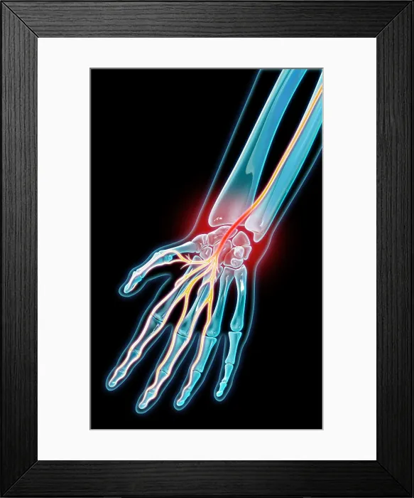 Framed Print : Carpal Tunnel Syndrome, Illustration Framed Print : Carpal Tunnel Syndrome, Illustration