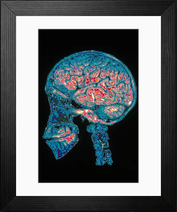 Framed Print : Human Skull X-Ray with Digitized Brain