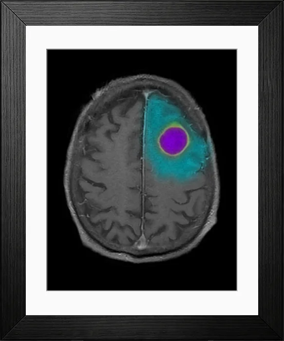 Framed Print : MRI of Encapsulated Abscess in Frontal Lobe Framed Print : MRI of Encapsulated Abscess in Frontal Lobe
