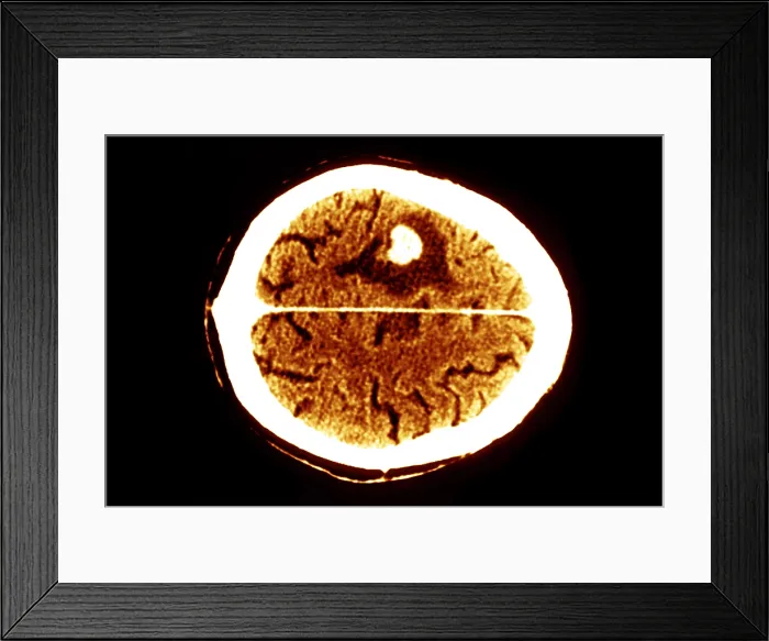 Framed Print : Brain edema Framed Print : Brain edema