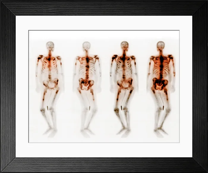 Framed Print : Bone scan showing multiple metastases Framed Print : Bone scan showing multiple metastases