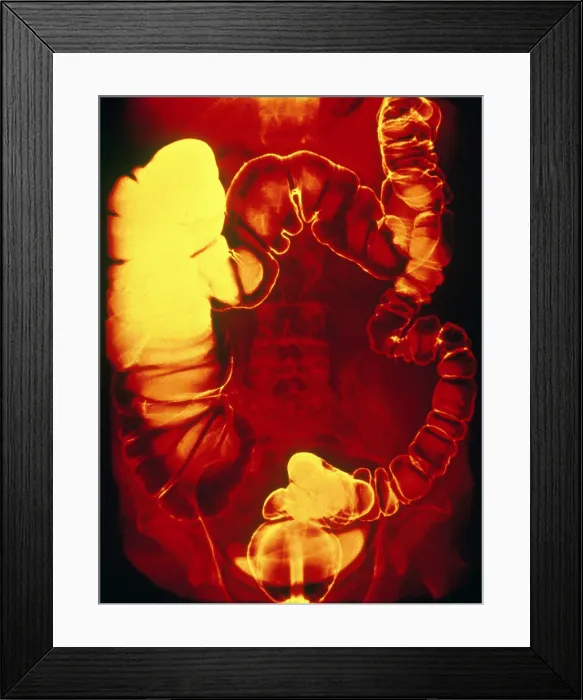 Framed Print : Large and Small Intestine, Barium X-ray Framed Print : Large and Small Intestine, Barium X-ray