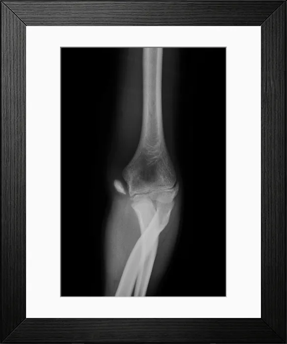 Framed Print : Little League Elbow Syndrome Framed Print : Little League Elbow Syndrome